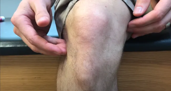 Cycling-induced knee cartilage damage