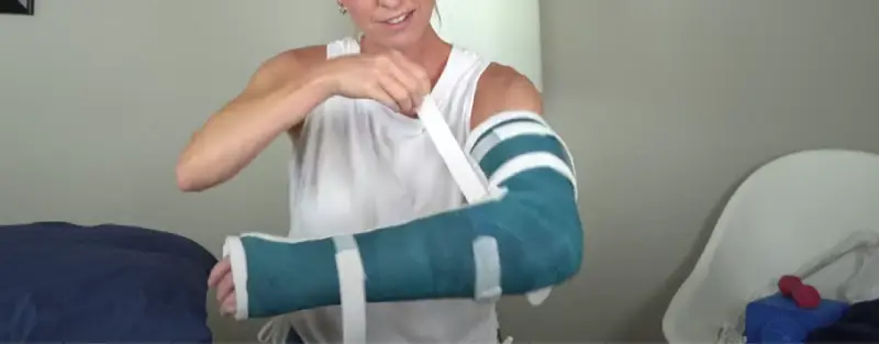 Broken Arm Healing Time [6 Factors That Affect Recovery]