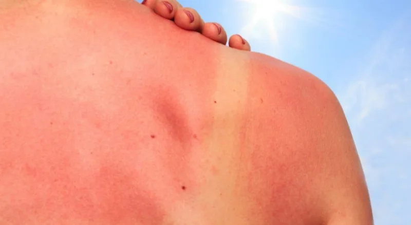 The 8 effects of sunburn on cycling