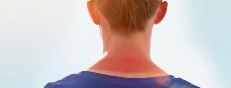 20 Ways To Get Rid Of Sunburn Redness Overnight For Cyclists