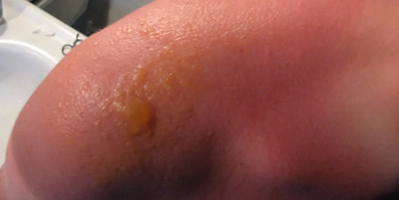 sunburn blisters pictures and 8 Best Ways To Treat Sunburn Blisters For Cyclists