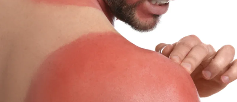 NSAIDs for Sunburn