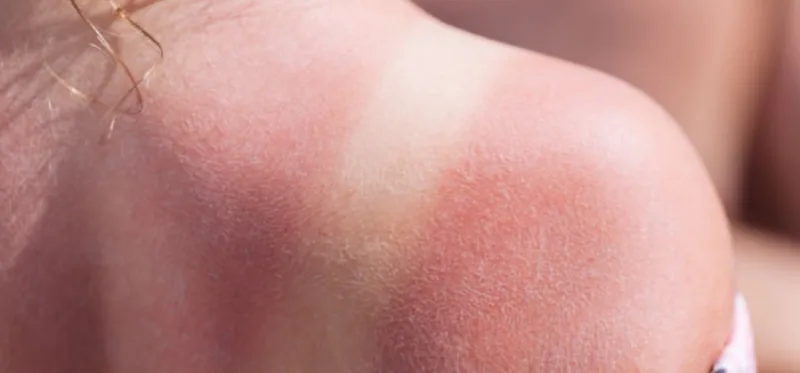 6 Risk Of Cyclists Getting Sunburned On A Cloudy Day