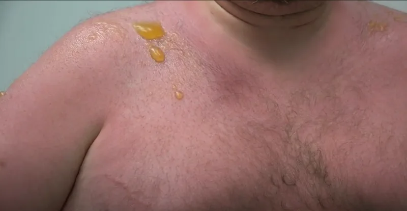 There are 15 reasons why sunburn blisters leak yellow fluid for cyclists