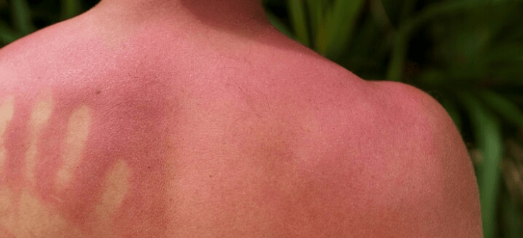 Supports Skin Regeneration