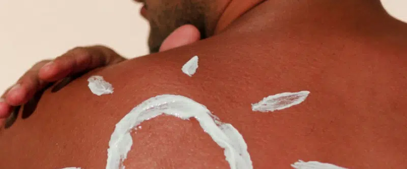 12 pros and cons of lotion for sunburn and 8 precautions to take