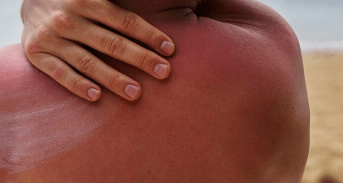 Skin Irritation