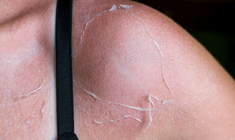 When To Apply Aloe Vera To Sunburn After Cycling: Frequency