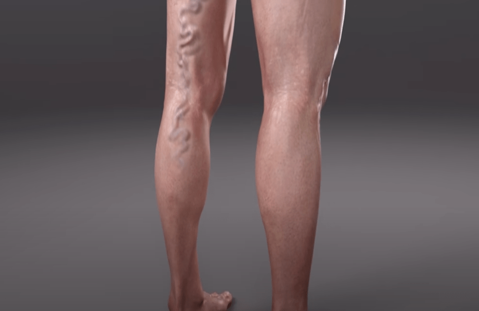 Muscles and varicose veins in the legs