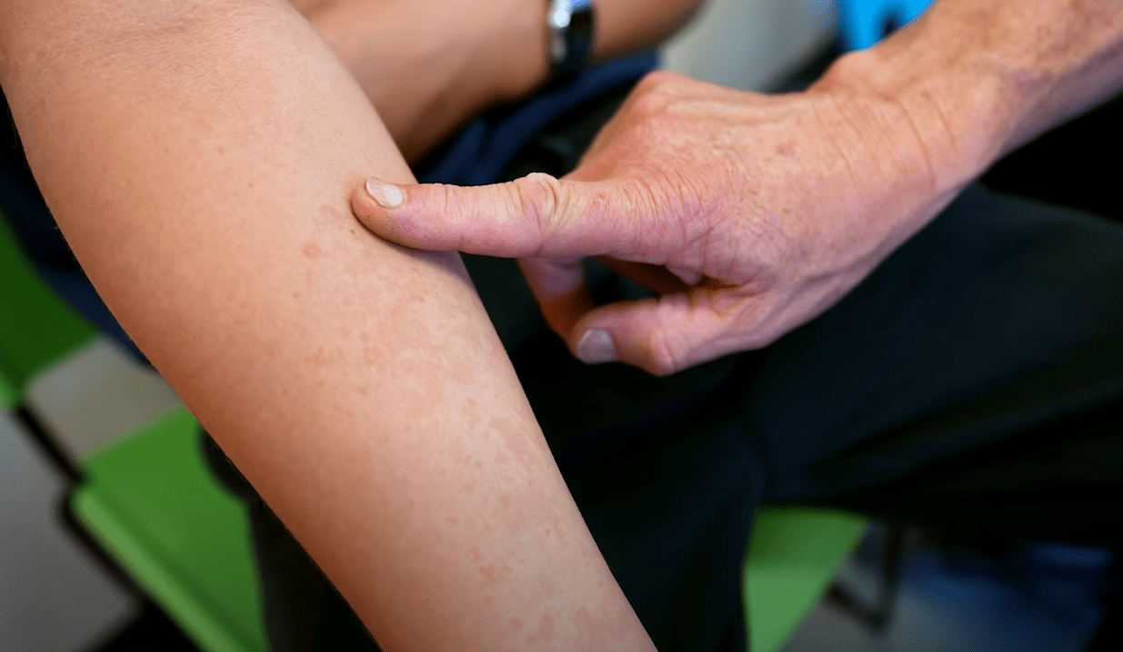 4 Side Effects of Witch Hazel Sunburn Treatment