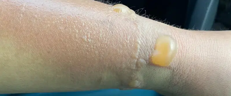 Cyclists' Sunburn Blisters Leaking Yellow Fluid: 9 Effects and 15 Causes