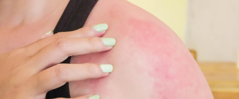 13 Symptoms Of Sunburn Poisoning For Cyclists And 7 Tips To Prevent It