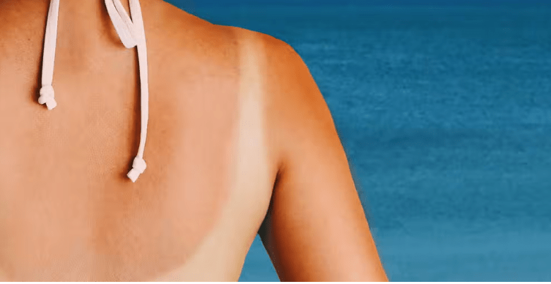 5 benefits of Benadryl for sunburn after cycling