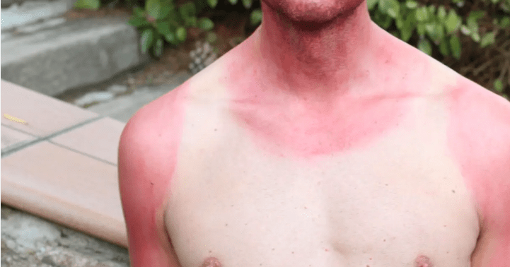 6 Reasons You May Get Sunburned While Cycling