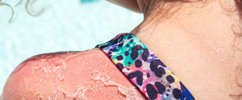 6 Ways to Prevent Sunburns After Cycling