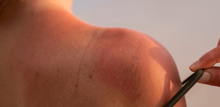 9 Precautions Use Benadryl for Sunburn after Cycling