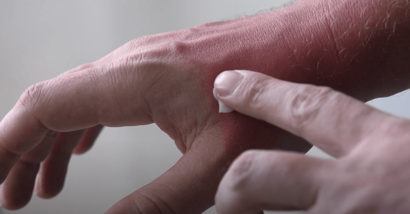 Allergic Reactions and Patch Testing