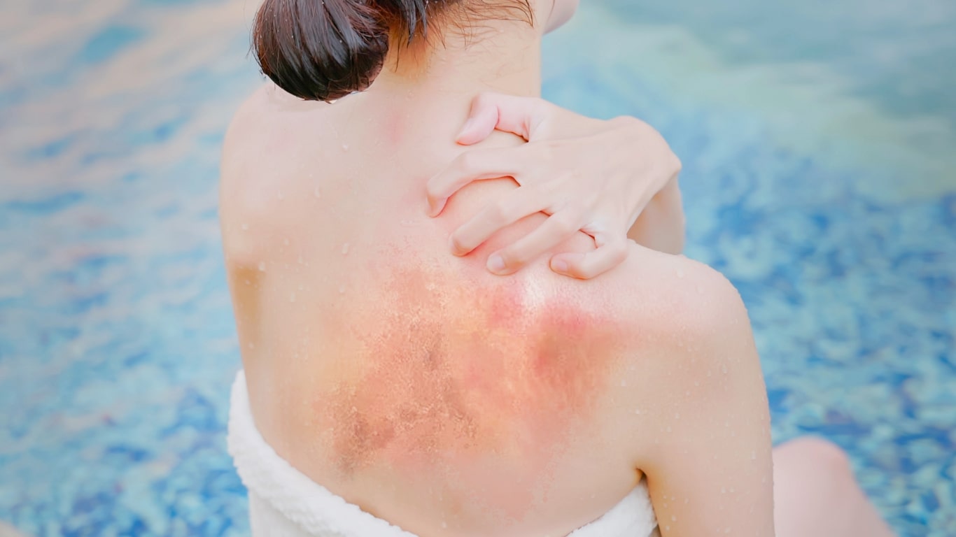 Salt Water for Sunburn Relief After Cycling