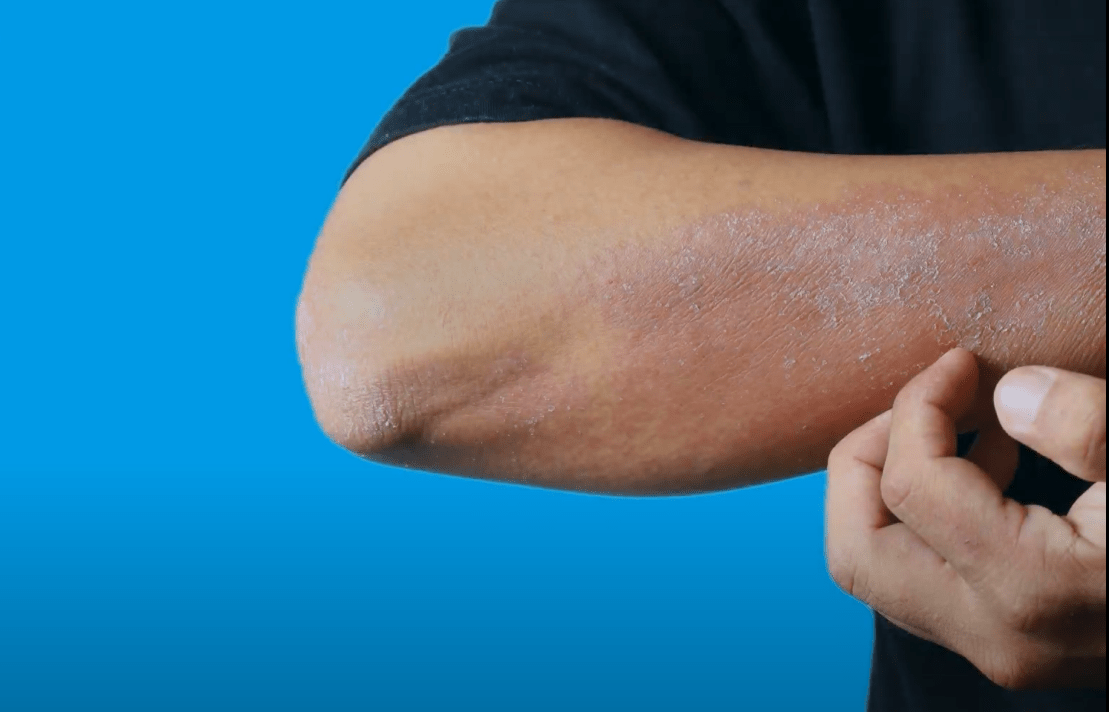 The 9 Causes of Purple Sunburn After Cycling