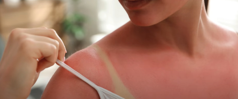 The Benefits and Mechanisms of Epsom Salt for Sunburn Treatment