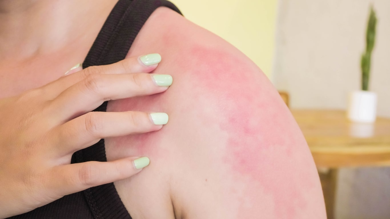 The risk of further irritation of the skin