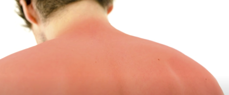What Causes Purple Sunburn After Cycling