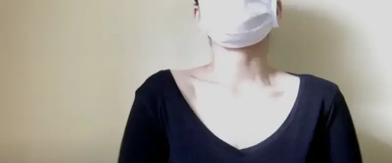 A before and after comparison of neck fat reduction