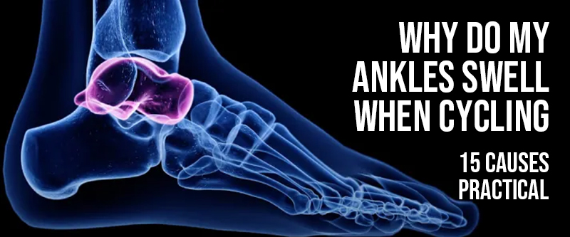 A cyclist with a swollen ankle (edema) after a ride