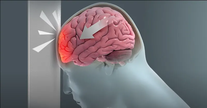 A diagram of a traumatic brain injury (TBI) in the skull