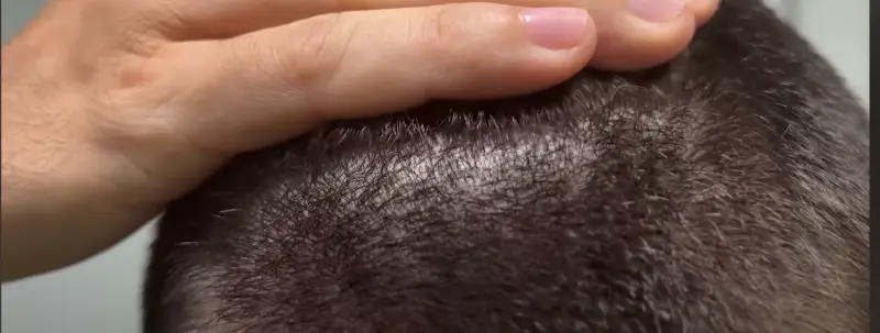 A dirty helmet liner that can worsen dandruff