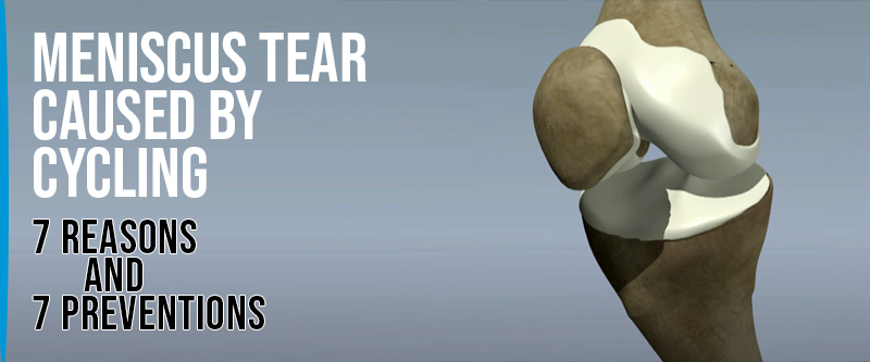 Anatomical diagram of a meniscus tear in the knee