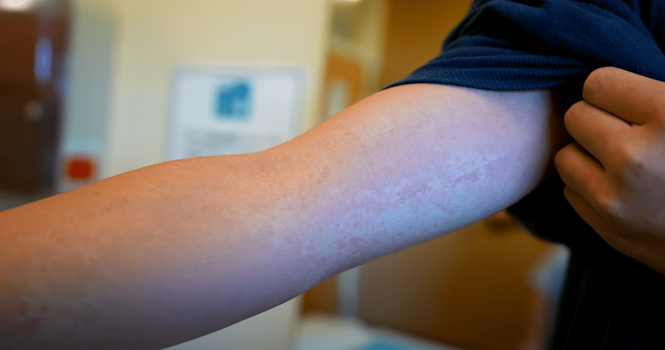 Aquaphor benefits for cyclists with sun damage