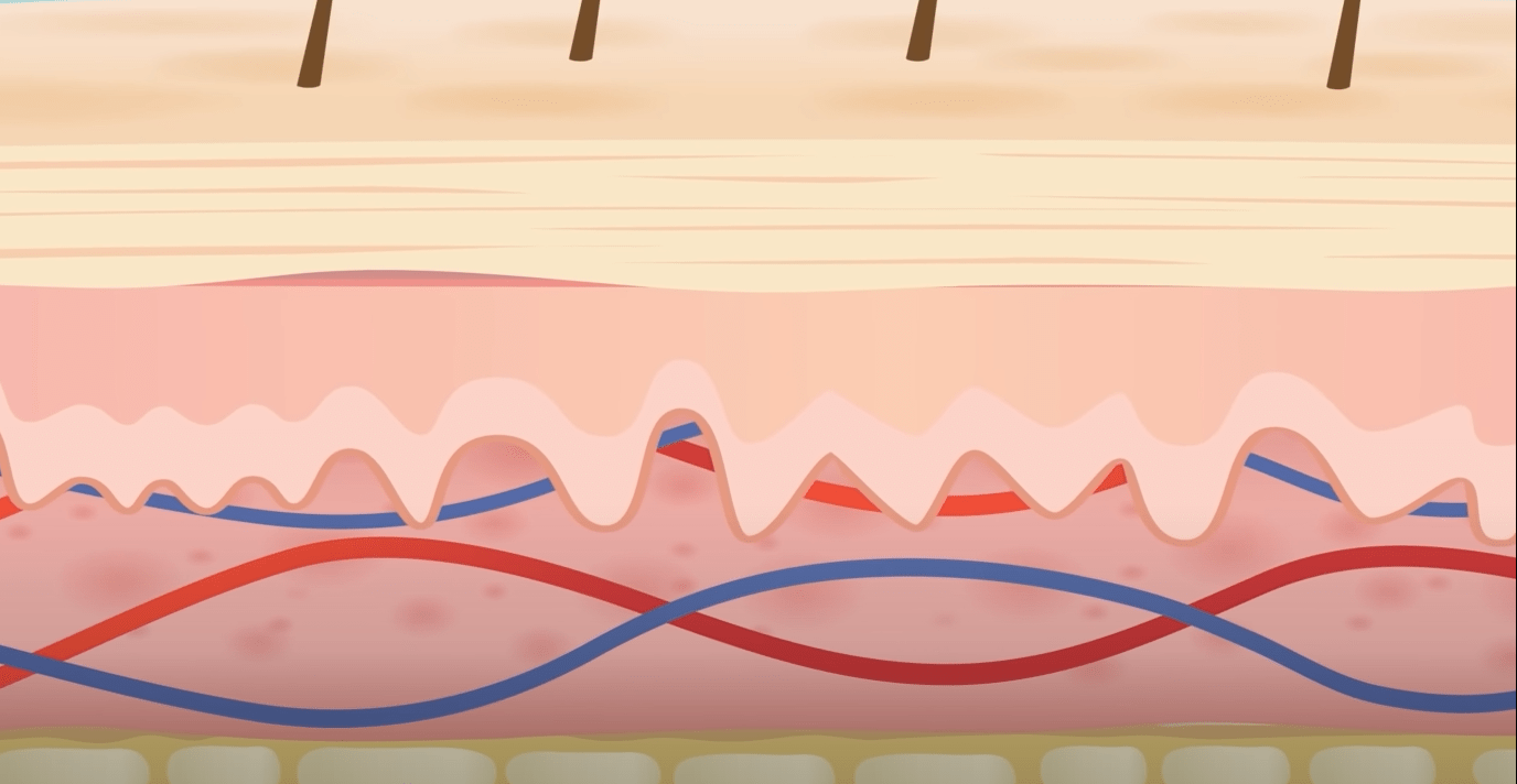 Before and after Aquaphor sunburn treatment