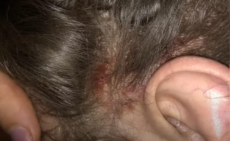 Cyclist with itchy scalp on summer ride