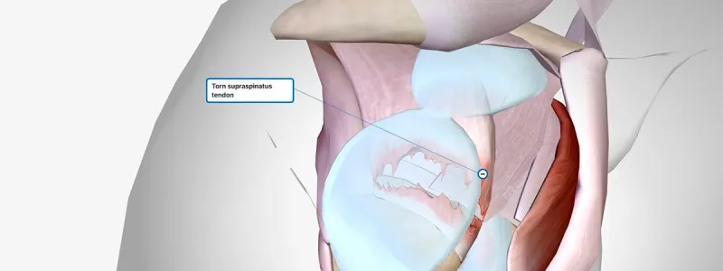 Diagram of an AC joint shoulder separation injury