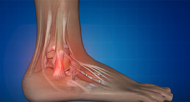 Diagram of blood flow and fluid retention in the leg