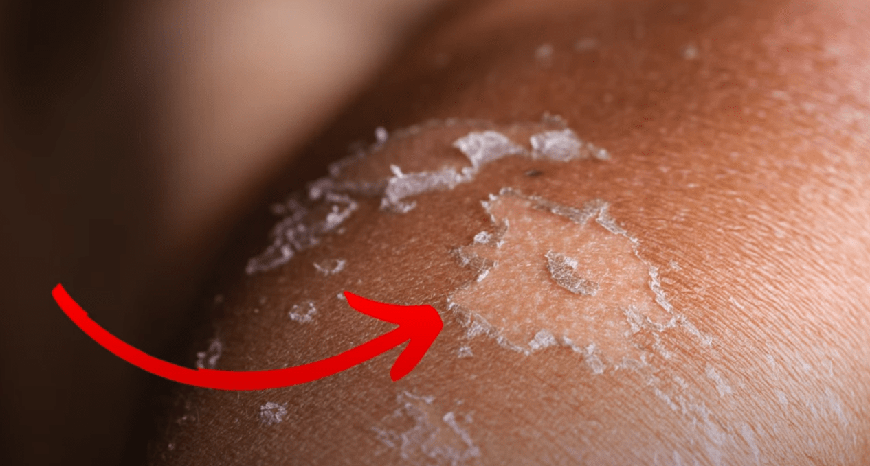 Red Skin Irritation from Sunburned Ride