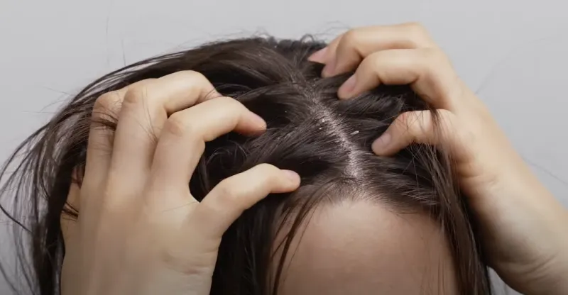Sweaty cycling helmet causing scalp irritation