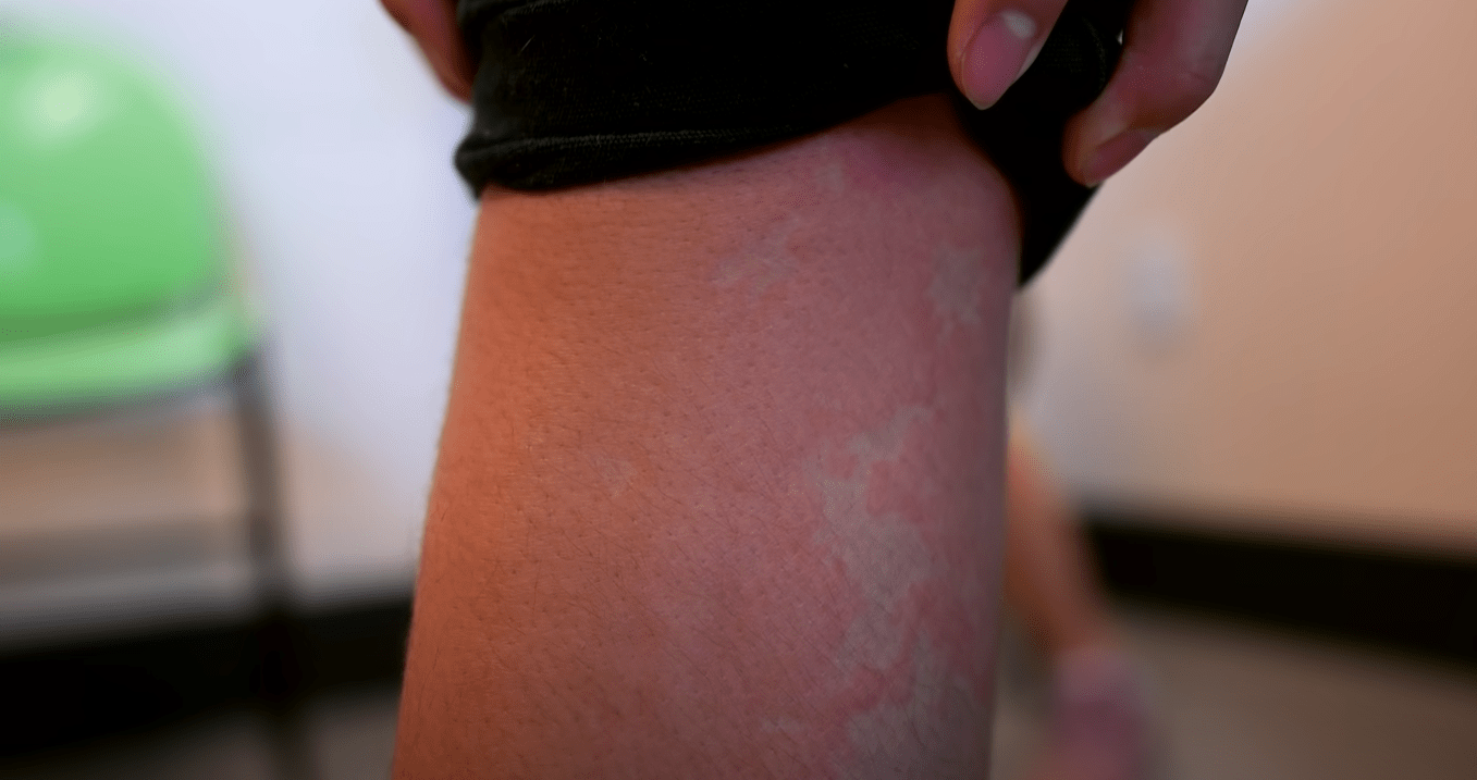 Using a cool compress on a sunburn for immediate comfort