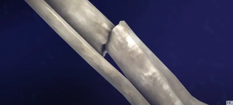 X-ray image of an ankle replacement implant